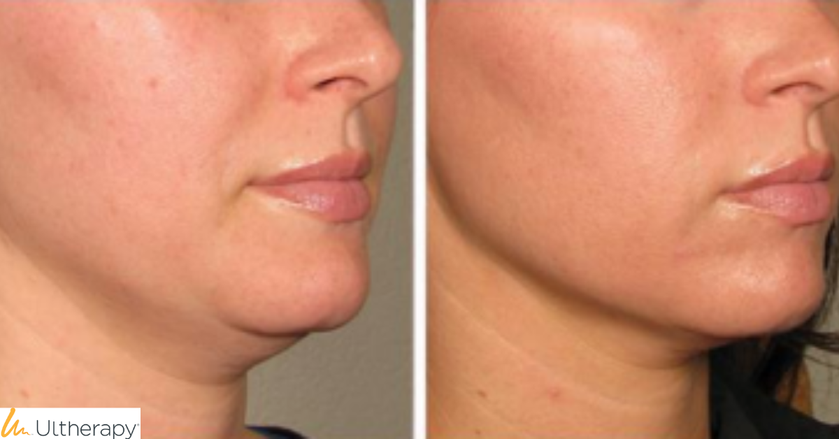 non surgical facelifts in cambridge