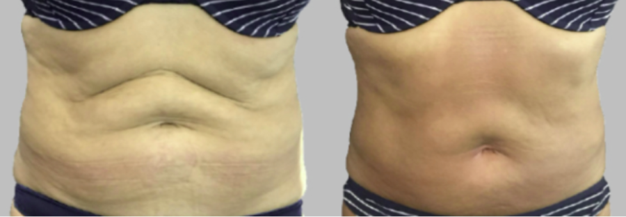 Exilis ultra treatment cambridge