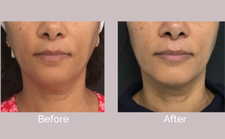 The Body Work Clinic Ultherapy Before & After