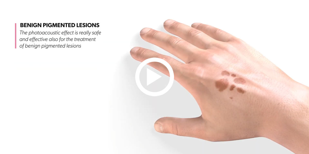 Benign Pigmented Lesions video