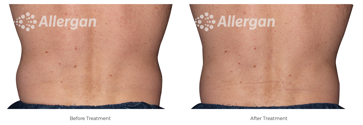 Coolsculpting treatment before and after side-by-side photos of person's back