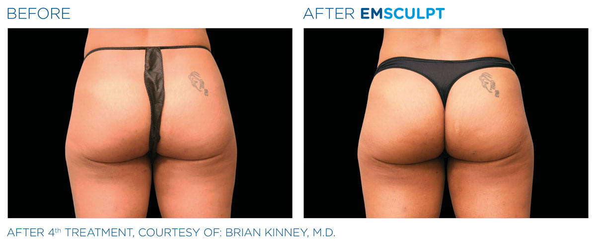 Emsculpt Female Buttock Alternative