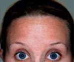 Forehead Worry lines