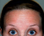 Forehead Worry lines