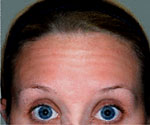 Forehead Worry lines