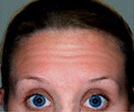 Forehead Worry lines