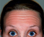 Forehead Worry lines