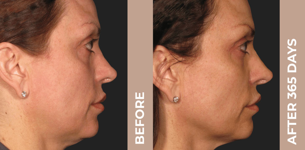 Ultherapy - before and after treatment