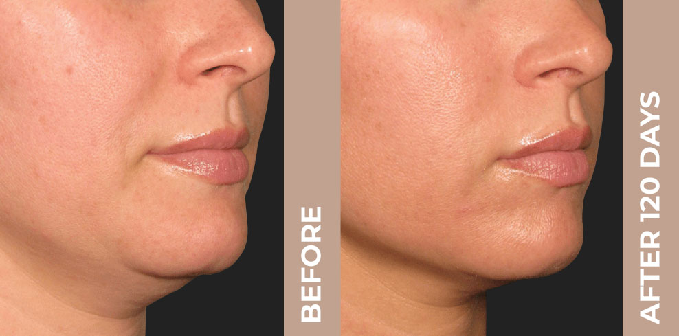 Ultherapy - before and after treatment