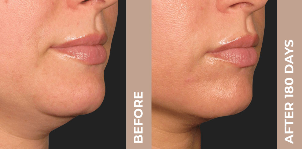 Ultherapy - before and after treatment