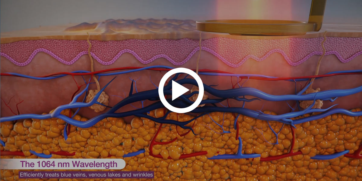 Video showing treatment options for veins